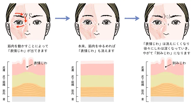 目尻のしわの形成メカニズム