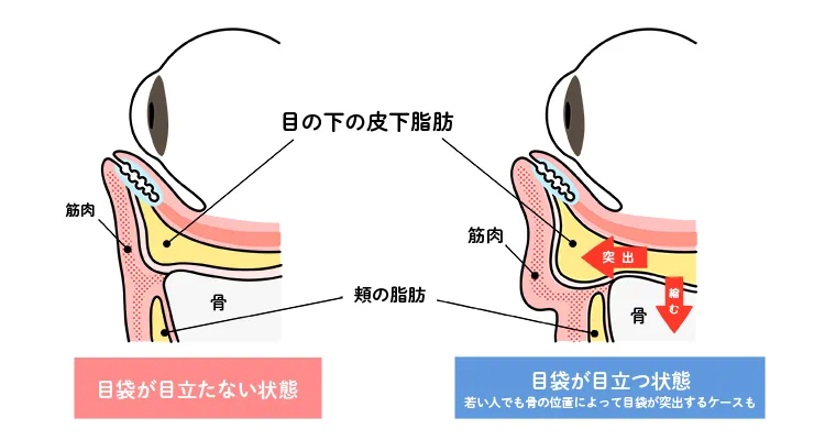 加齢で黒クマが生じやすくなる顔内部の変化