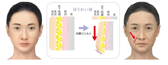 加齢によるほうれい線についての画像