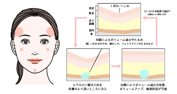 骨のボリュームロスを補えるヒアルロン酸注入治療