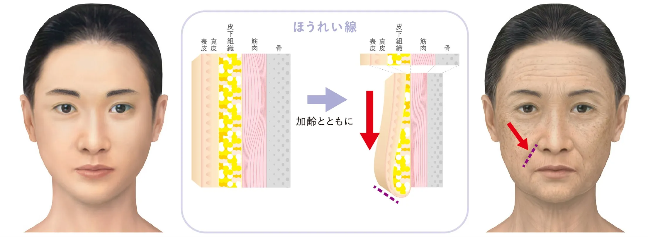 ほうれい線の加齢の変化の画像