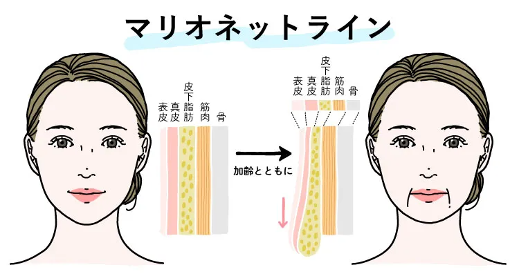 マリオネットラインの根本的な原因、肌のたるみが起きる説明図