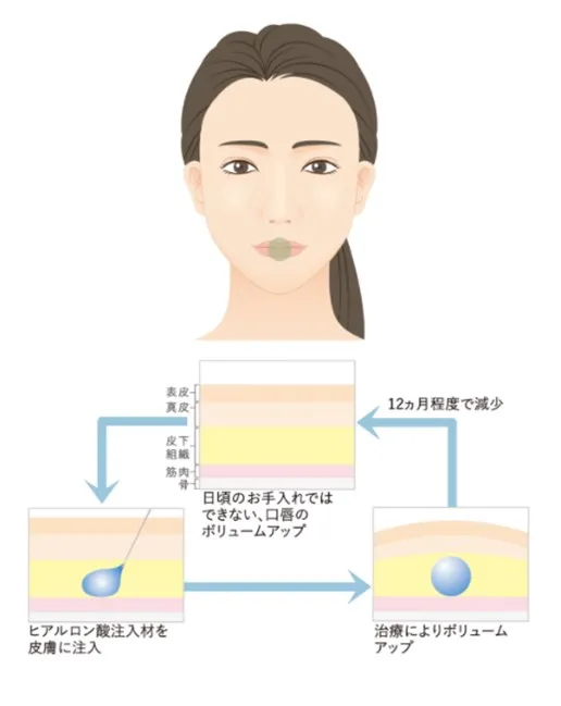 ヒアルロン酸注入が効果的な部位3の画像