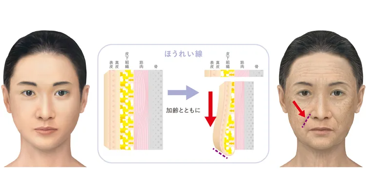 ほうれい線の根本的な原因、肌のたるみが起きる説明図