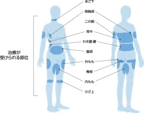 脂肪冷却治療が受けられる部位の画像