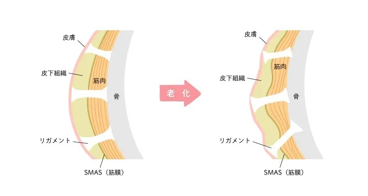 頬がこける要因の一つ、支持靭帯とSMASの衰え